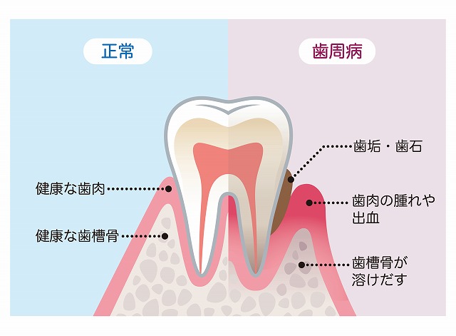 歯周病