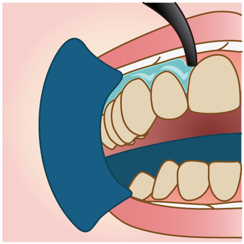 歯ぐきのケア